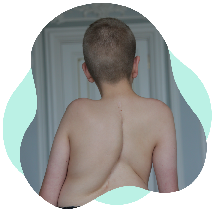 Neuromuscular scoliosis