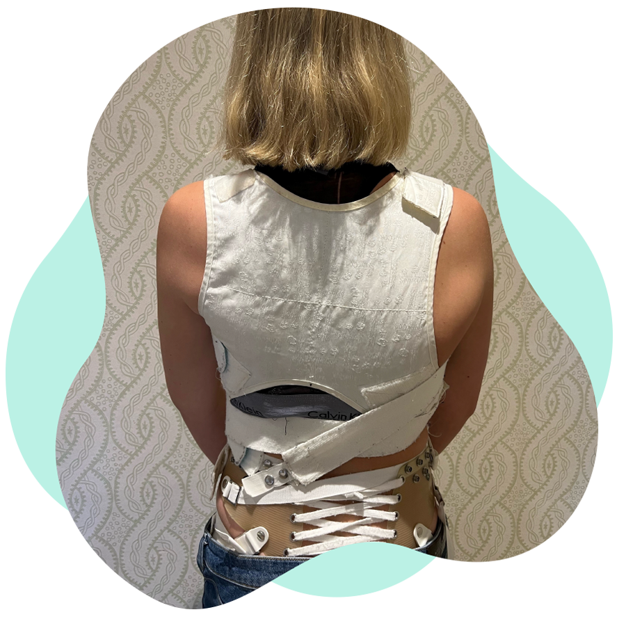 Scoliosis back bracing treatment